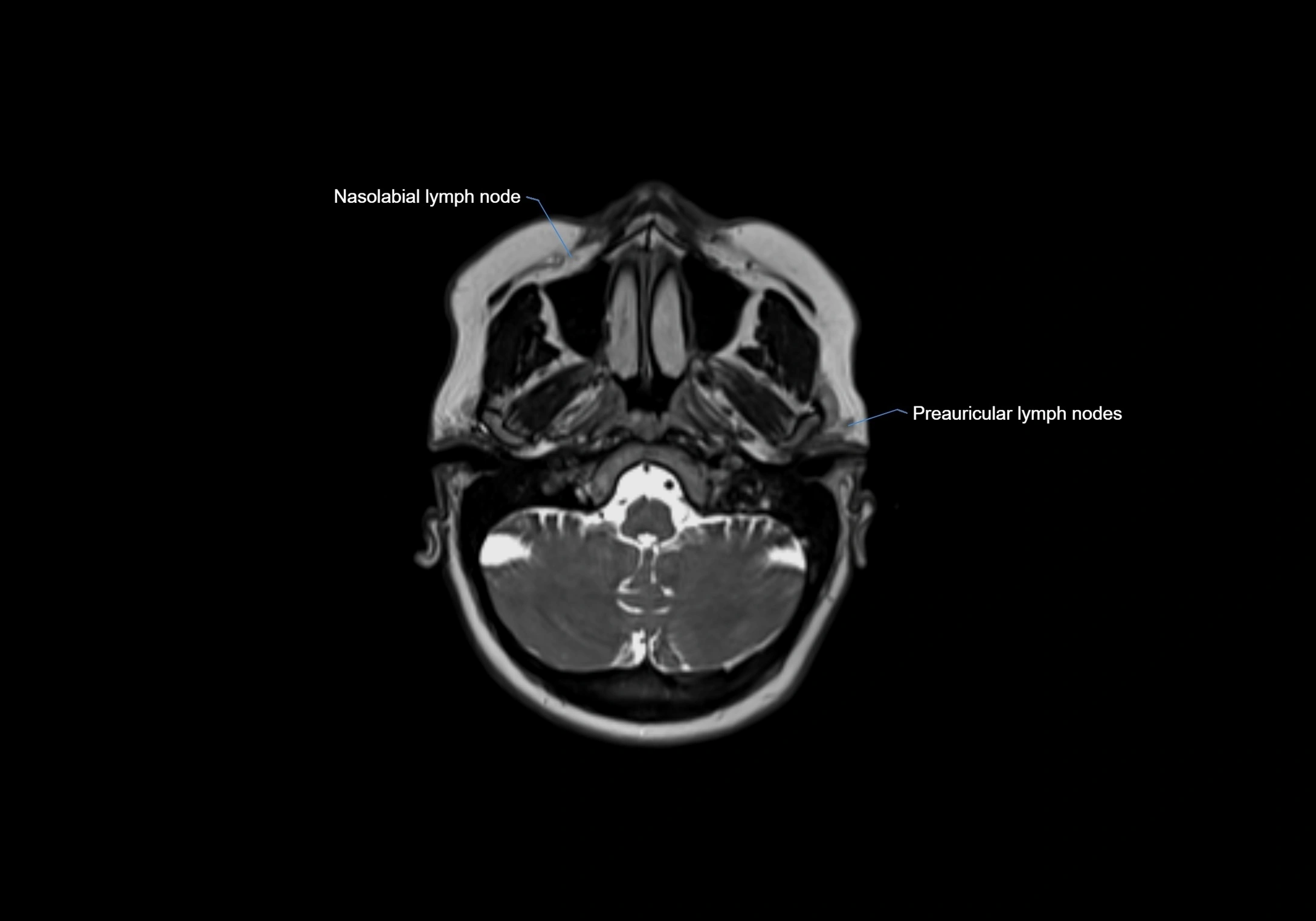 Neck axial  lymph node cross sectional MRI anatomy 3T MRI  image-img-00001-00020.webp